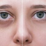 Transforming tired eyes into youthful expressions with modern techniques